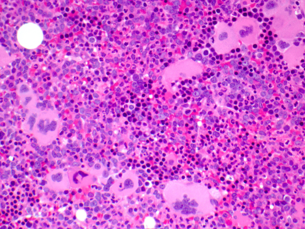 High power view of bone marrow biopsy showing clustered megakaryocytes.